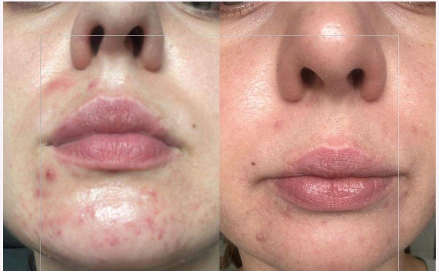 Hormonal Acne Skin