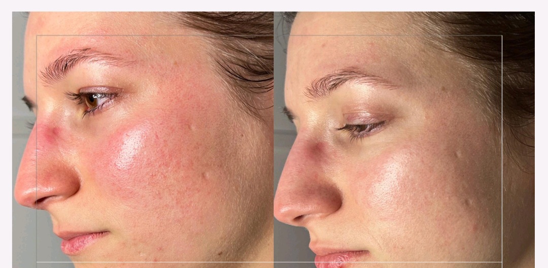 Redness Skin